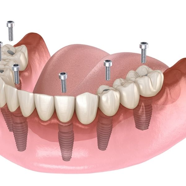 All-on-4 dental implant procedure