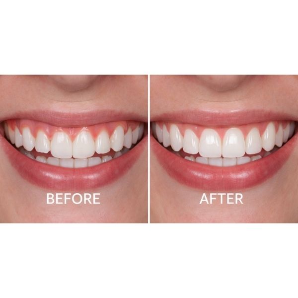 Gum contouring procedure