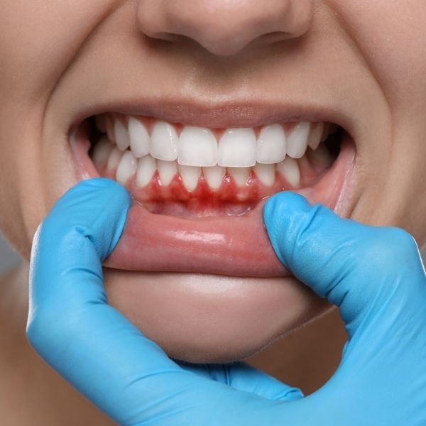 Gum disease treatment