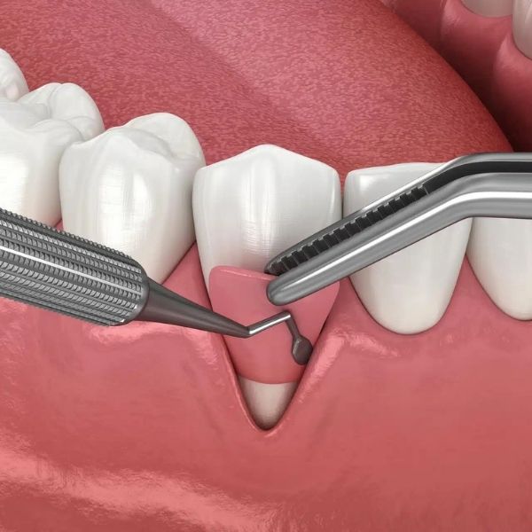 Gum grafting procedure