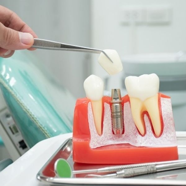 Periodontal treatment at Dental Sedation Ottawa