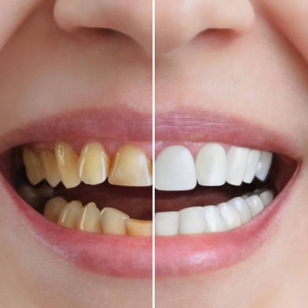 Professional teeth whitening treatment